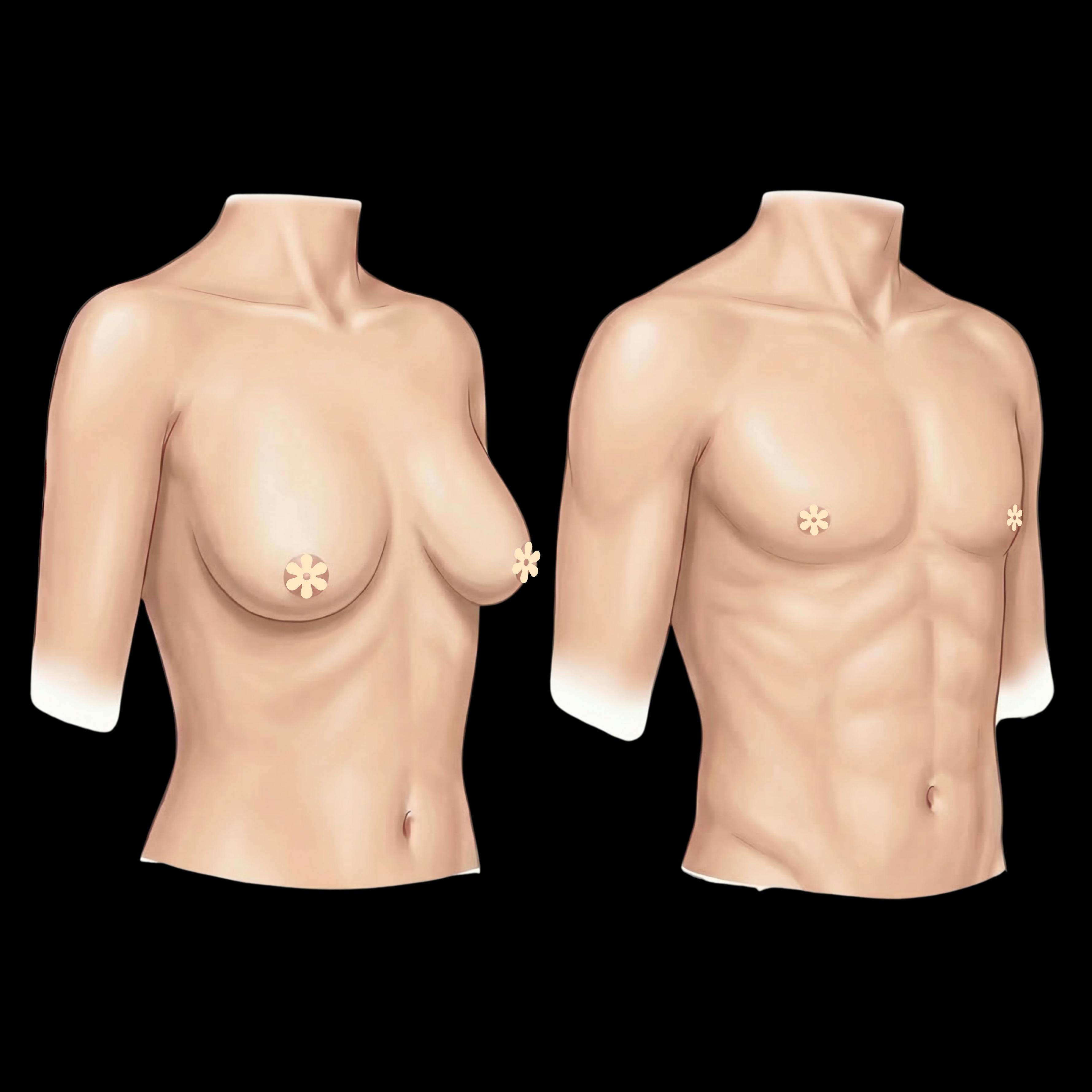 Abdominal Etching Liposuction — plastic surgery procedure