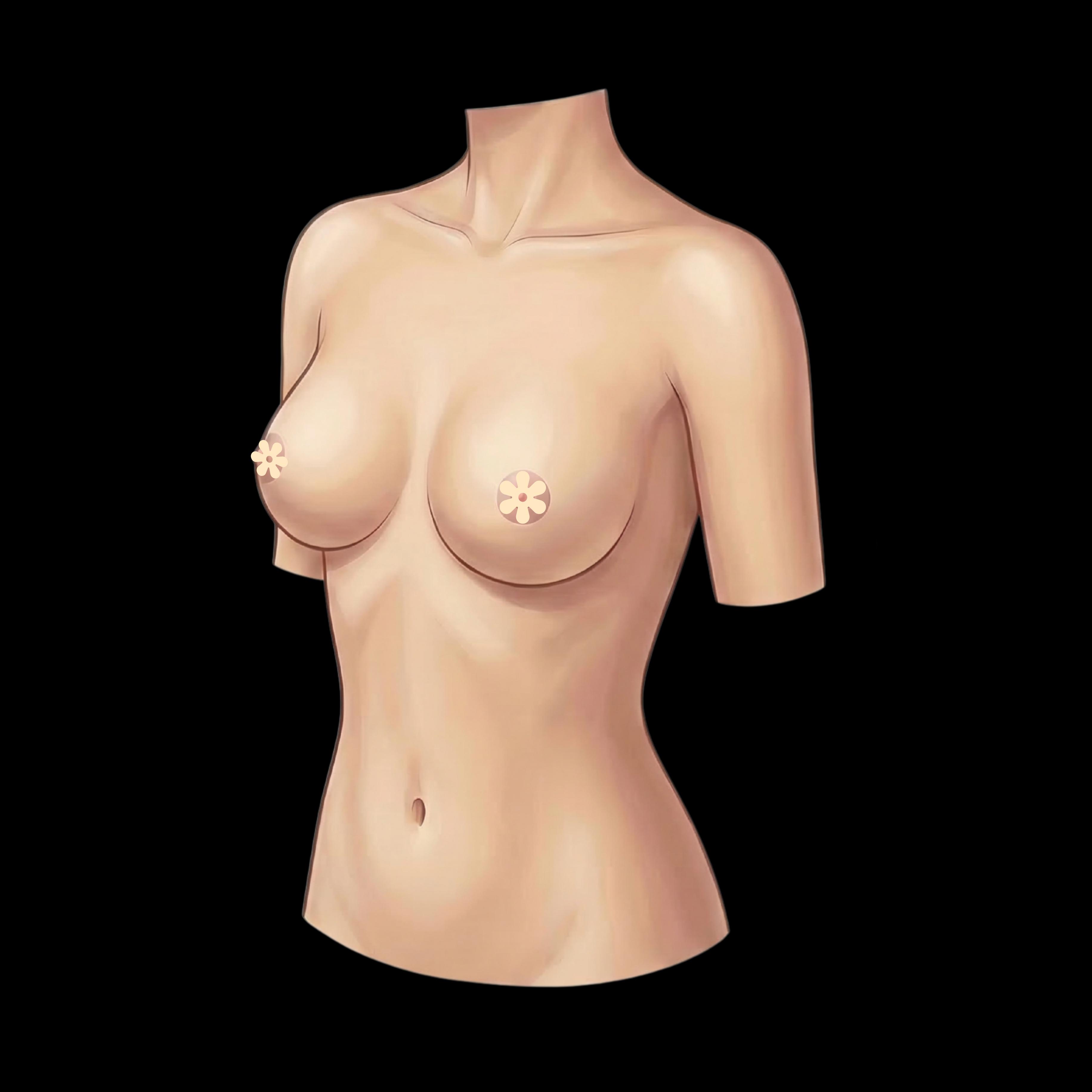 Mastopexy (Breast Lift) — plastic surgery procedure